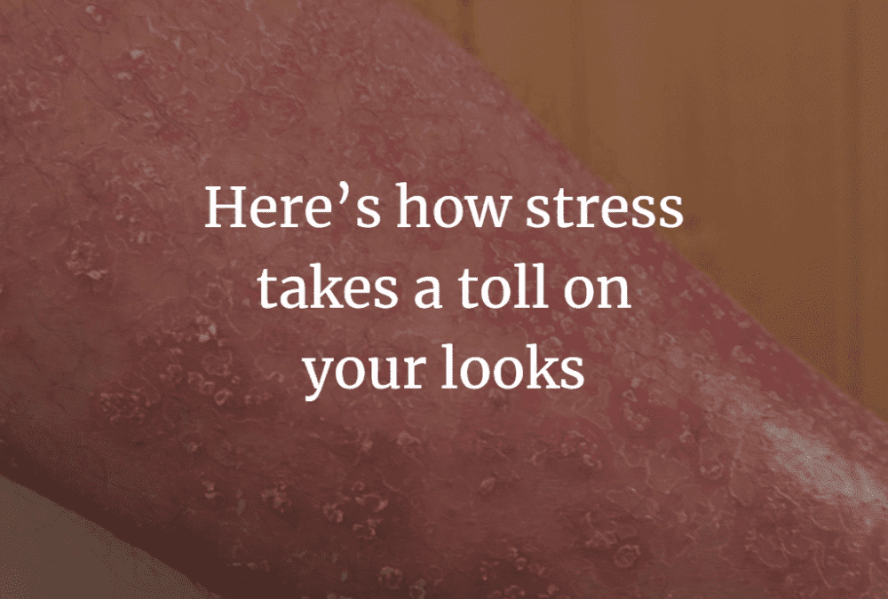 Stress and Skin: How stress takes a toll on your looks